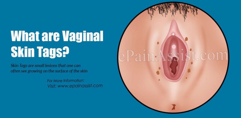 What Causes Vaginal Skin Tags & How To Get Rid Of Them?