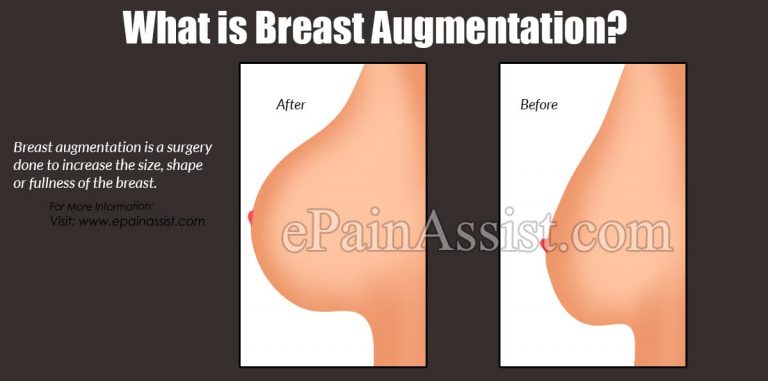 What is Breast Augmentation & Why is it Done?