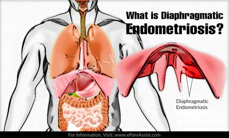 Symptoms  of Diaphragmatic Endometriosis & Its Treatment Options