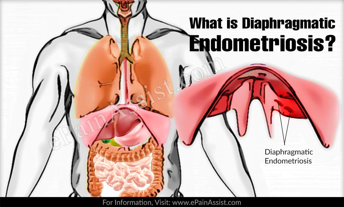 What is Diaphragmatic Endometriosis?