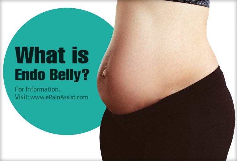 What is Endo Belly & How Can It Be Managed?