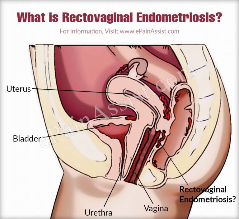 Presenting Features of Rectovaginal Endometriosis & Its Treatment Options