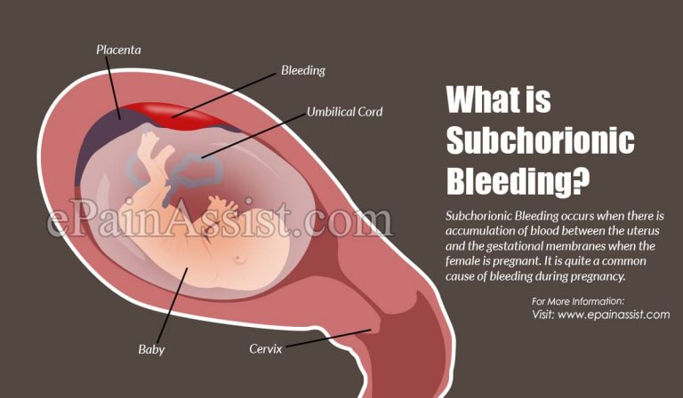 What is Subchorionic Bleeding & How is it Treated? | Causes, Symptoms, Diagnosis of Subchorionic Bleeding
