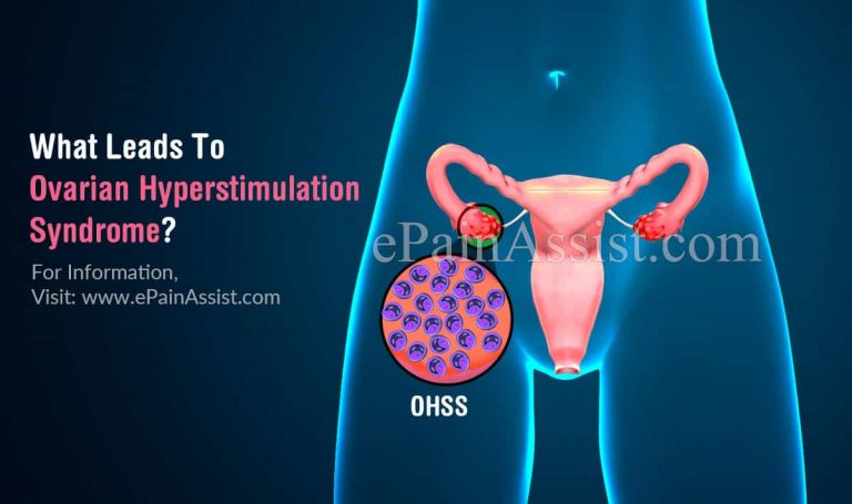 What Leads To Ovarian Hyperstimulation Syndrome & Can It Be Cured?