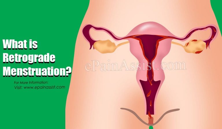 Retrograde Menstruation: Causes, Symptoms, Treatment, Diagnosis