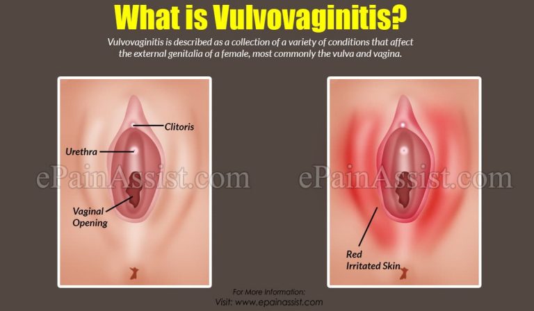 What Causes Vulvovaginitis & How Is It Treated?