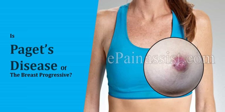 Is Paget’s Disease Of The Breast A Progressive Disease & Alternative Treatments For It?