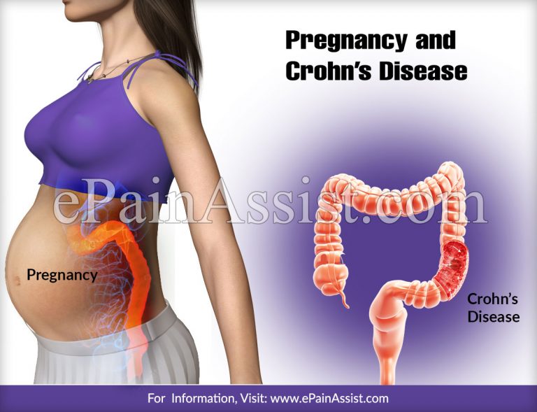Pregnancy and Crohn’s Disease