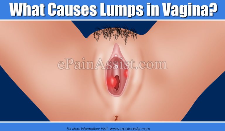 What Causes Lumps in Vagina & How is it Treated?
