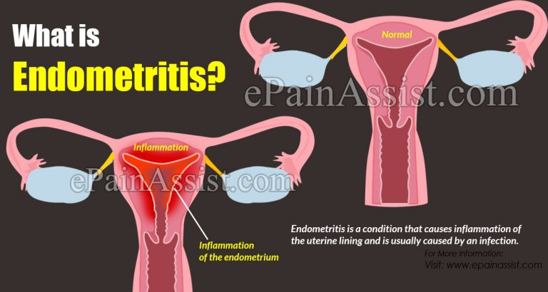 What is Endometritis: Causes, Symptoms, Treatment, Risk Factors, Complications