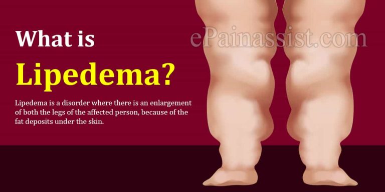 Lipedema: Causes, Symptoms, Treatment, Diet, Diagnosis