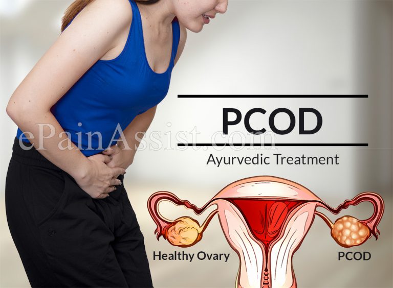 Ayurvedic, Allopathic and Homeopathic Treatment of PCOD