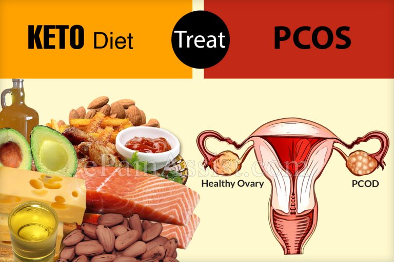 Can Keto Diet Treat PCOS?