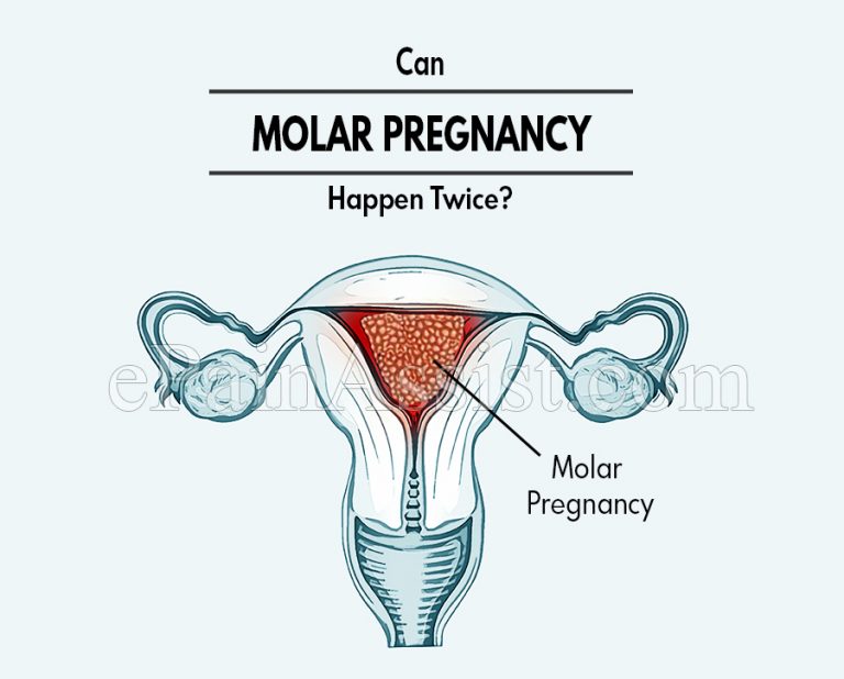 Can Molar Pregnancy Happen Twice?