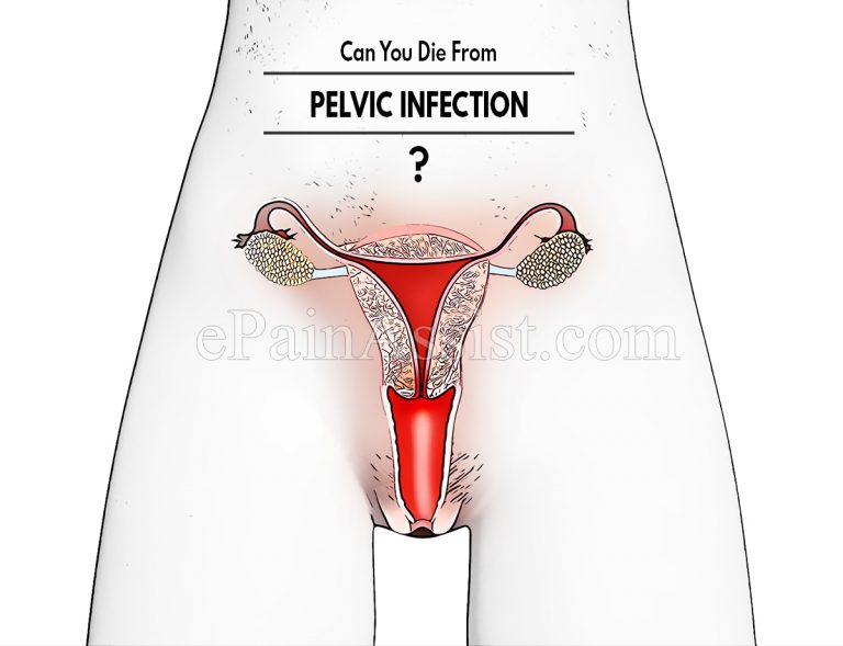 Can You Die From Pelvic Infection & How Do You Stop It From Spreading?