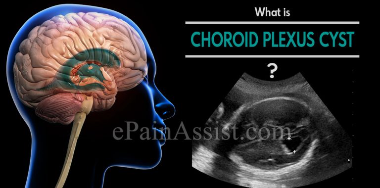 What is Choroid Plexus Cyst?