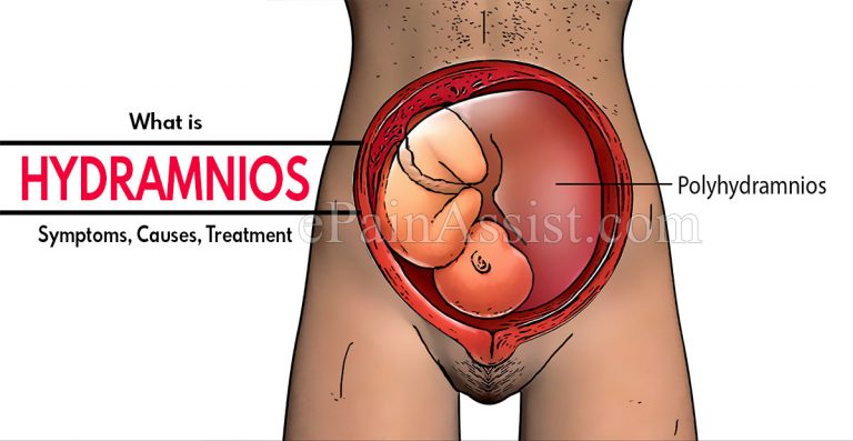 Hydramnios: Symptoms, Causes, Treatment and Diagnosis