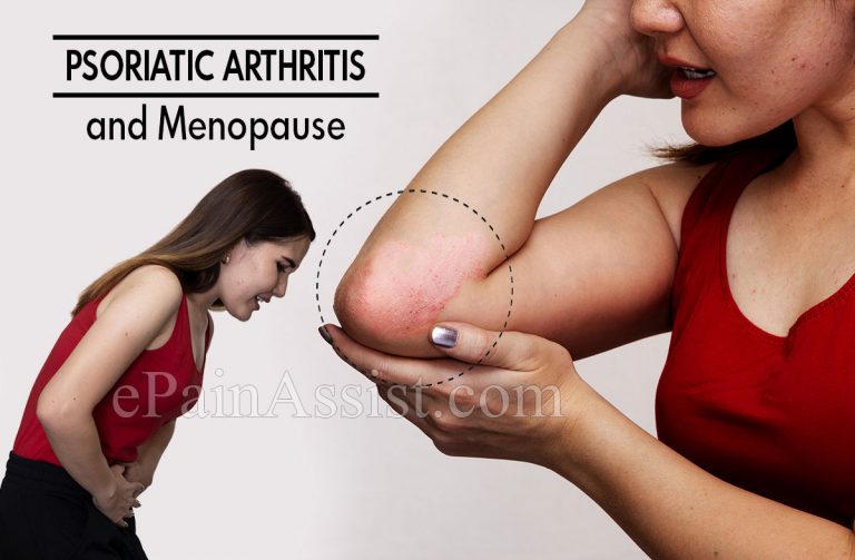 Psoriatic Arthritis and Menopause