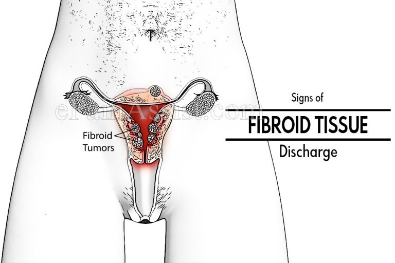 Signs of Fibroid Tissue Discharge