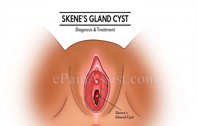 Skene’s Gland Cyst: Diagnosis & Treatment