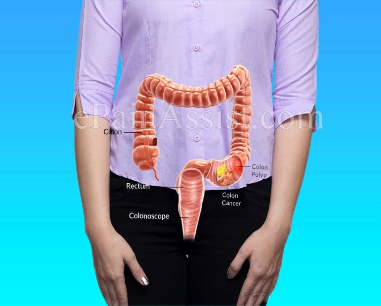 Symptoms of Bowel Cancer in Females
