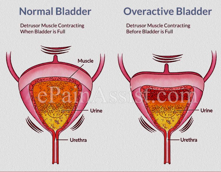 Why Does Menopause Increase the Risk of Overactive Bladder?