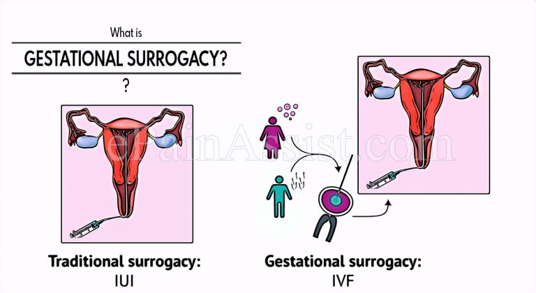 What is Gestational Surrogacy?
