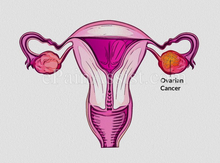 Why is it Challenging to Diagnose Ovarian Cancer & What Happens After a Diagnosis of Ovarian Cancer?