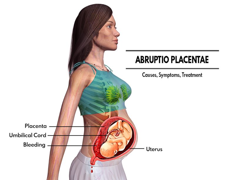 Abruptio Placentae : Causes, Symptoms, Diagnosis, Treatment, Recovery
