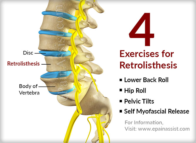 4 Exercises for Retrolisthesis