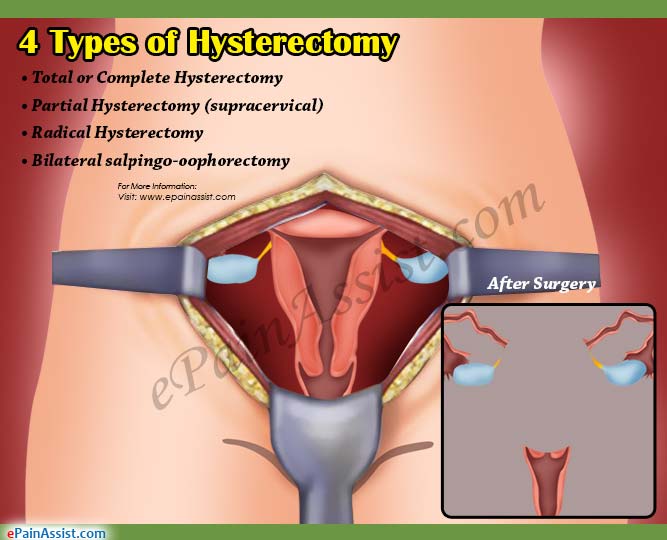 4 Types of Hysterectomy