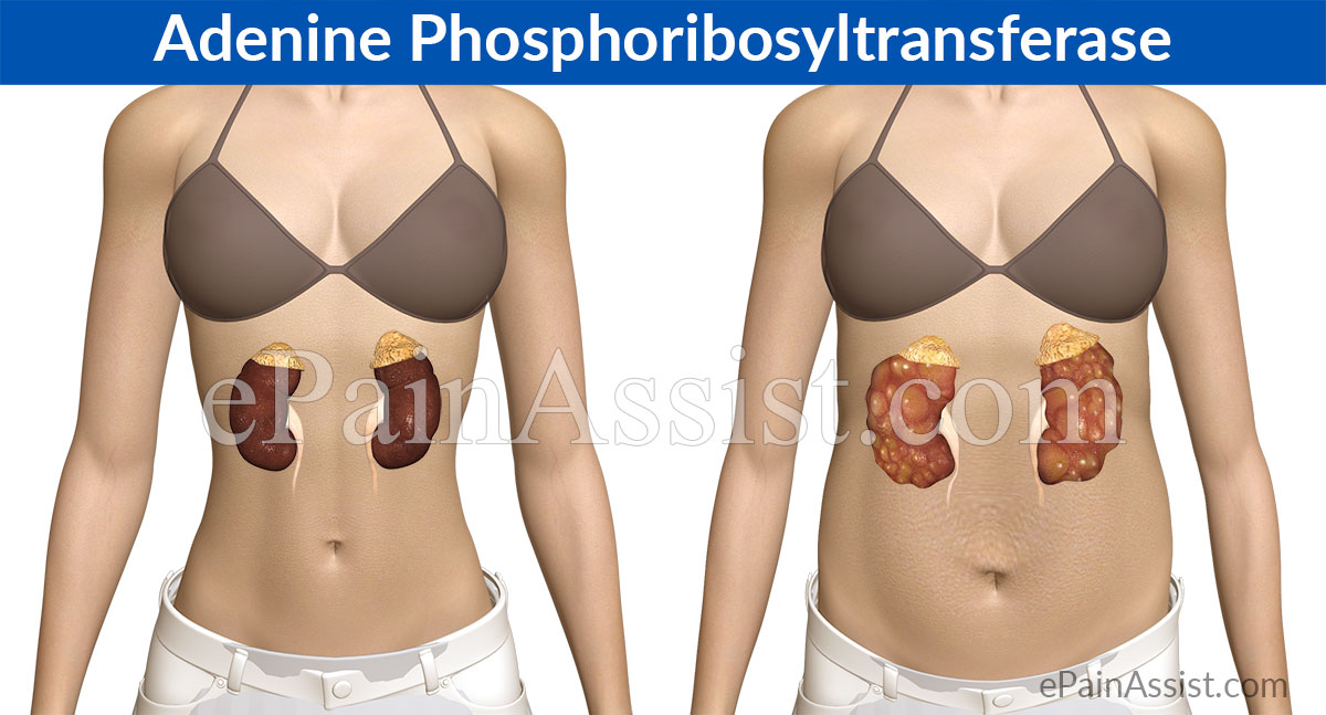Adenine Phosphoribosyltransferase or APRT Deficiency Adenine Phosphoribosyltransferase or APRT Deficiency