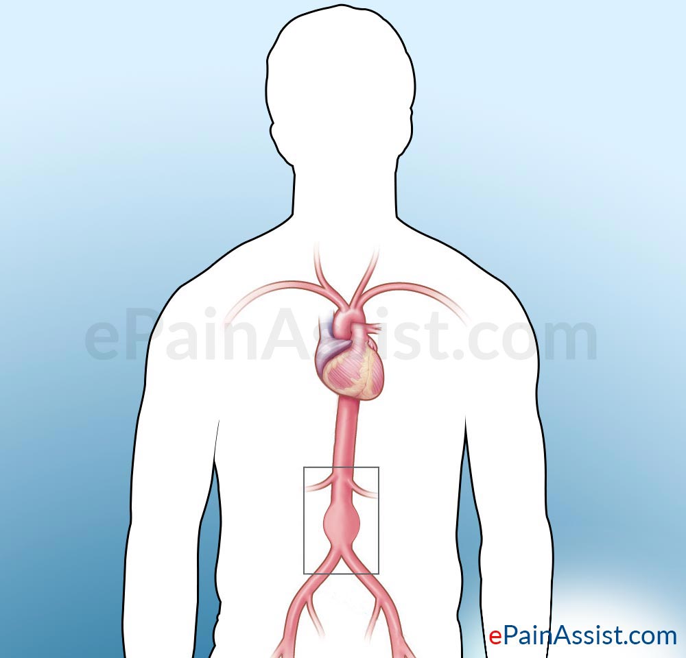 Abdominal Aortic Aneurysm