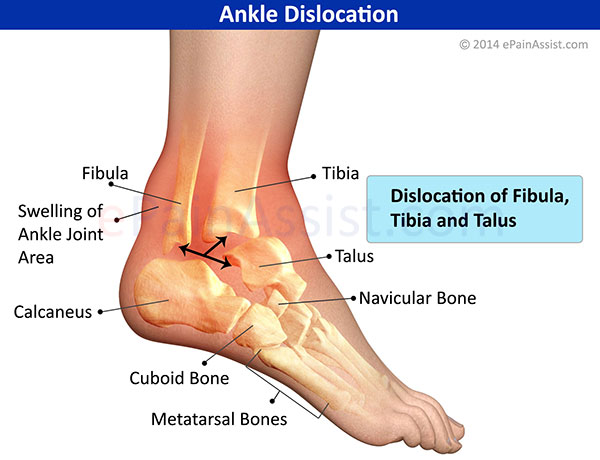 Dislocated Ankle or Ankle Dislocation