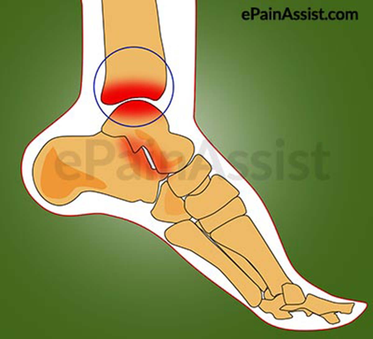 Ankle Joint Pain Ankle Joint Pain