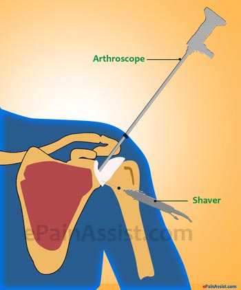 Joint Arthroscopy