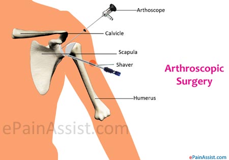 Arthroscopic Surgery