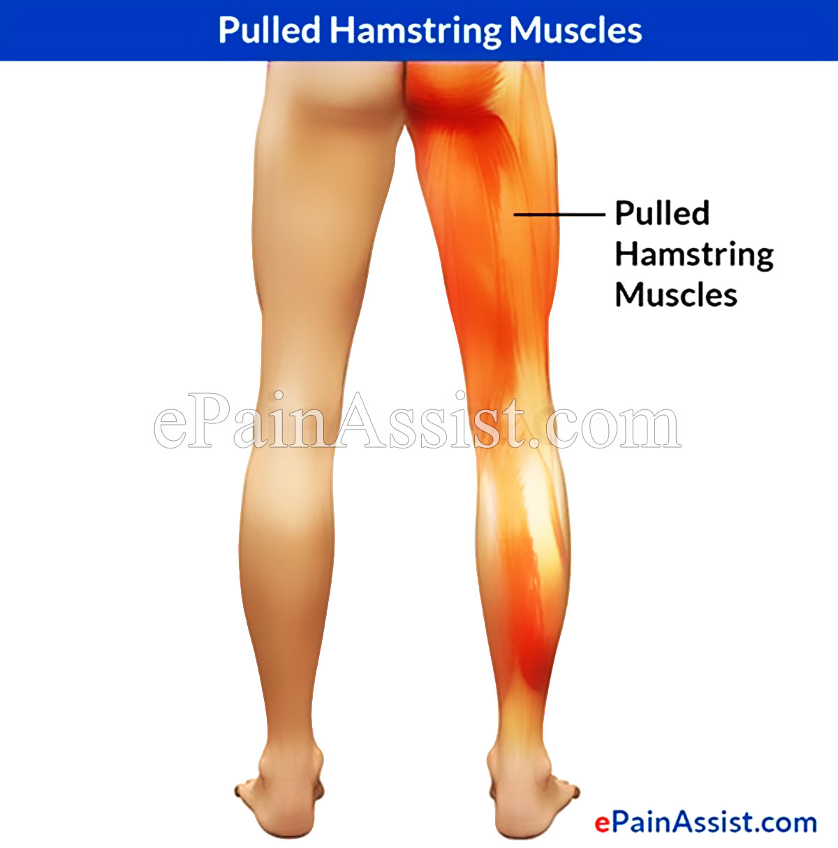 Pulled Hamstring Muscles