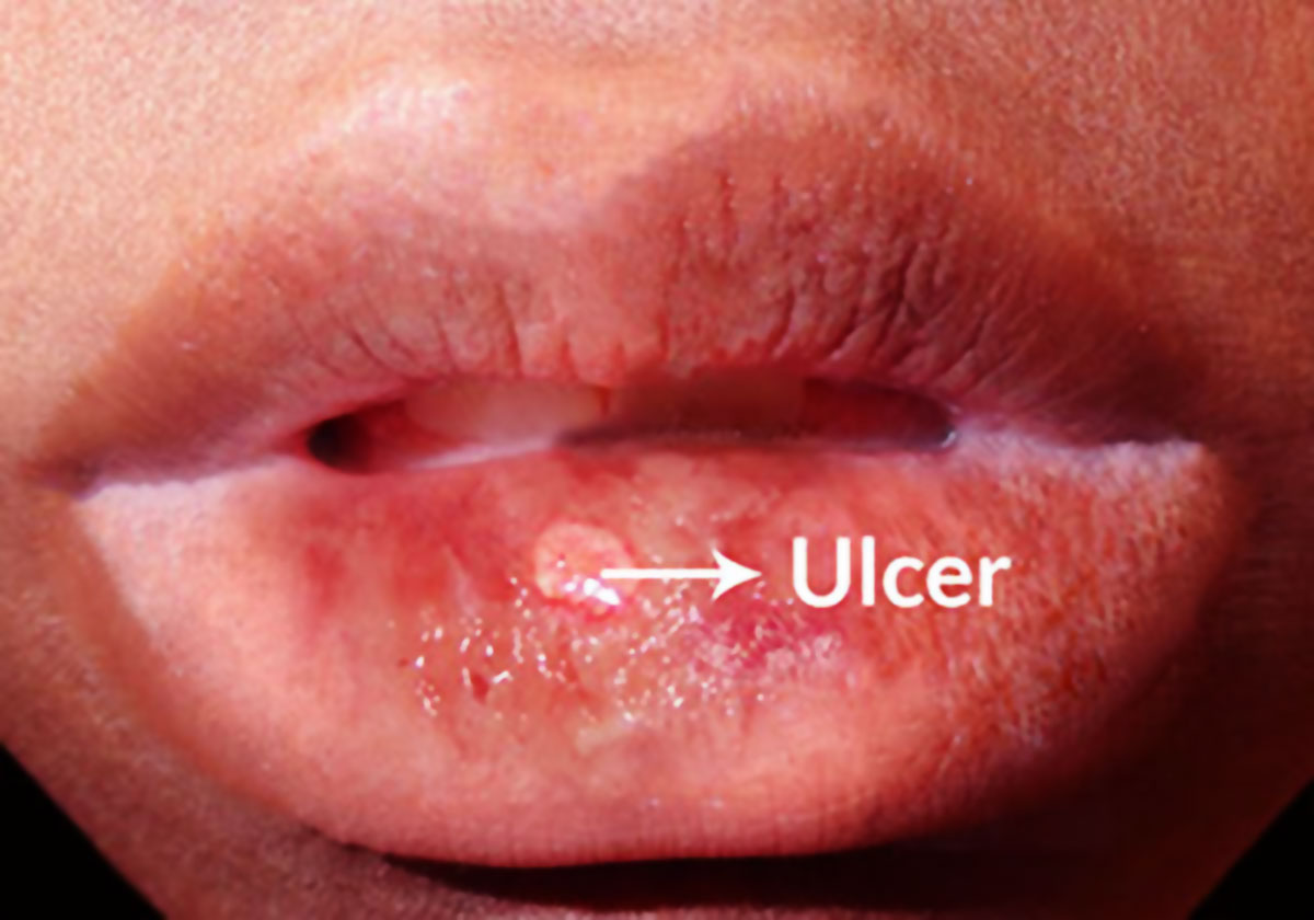 Symptoms of Behcet's Disease or Behcet's Syndrome Symptoms of Behcet's Disease or Behcet's Syndrome
