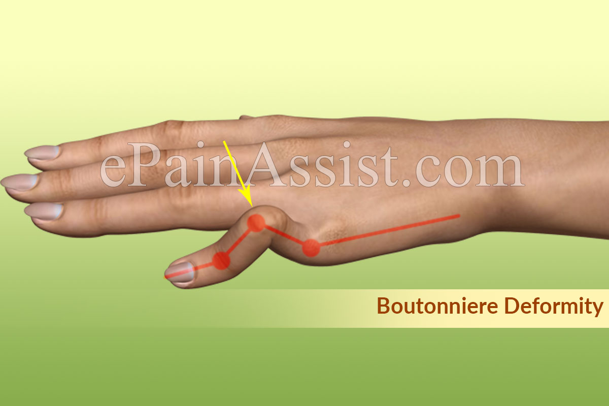 Boutonniere Deformity Boutonniere Deformity