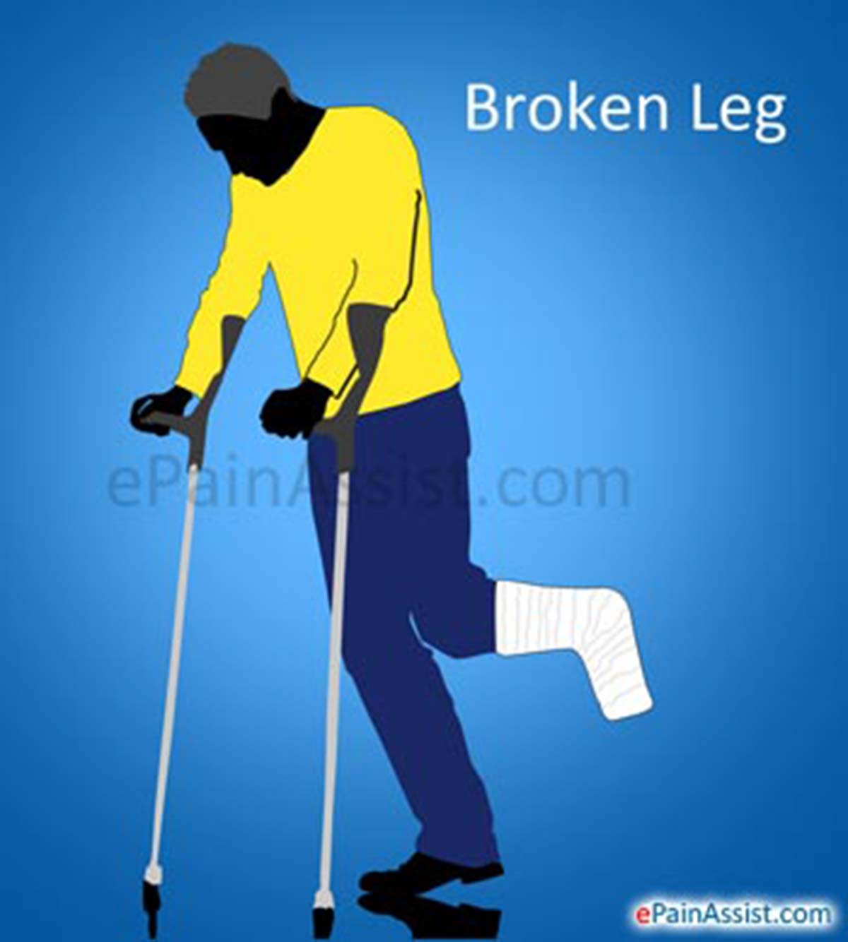 Broken Leg or Fractured Leg Broken Leg or Fractured Leg