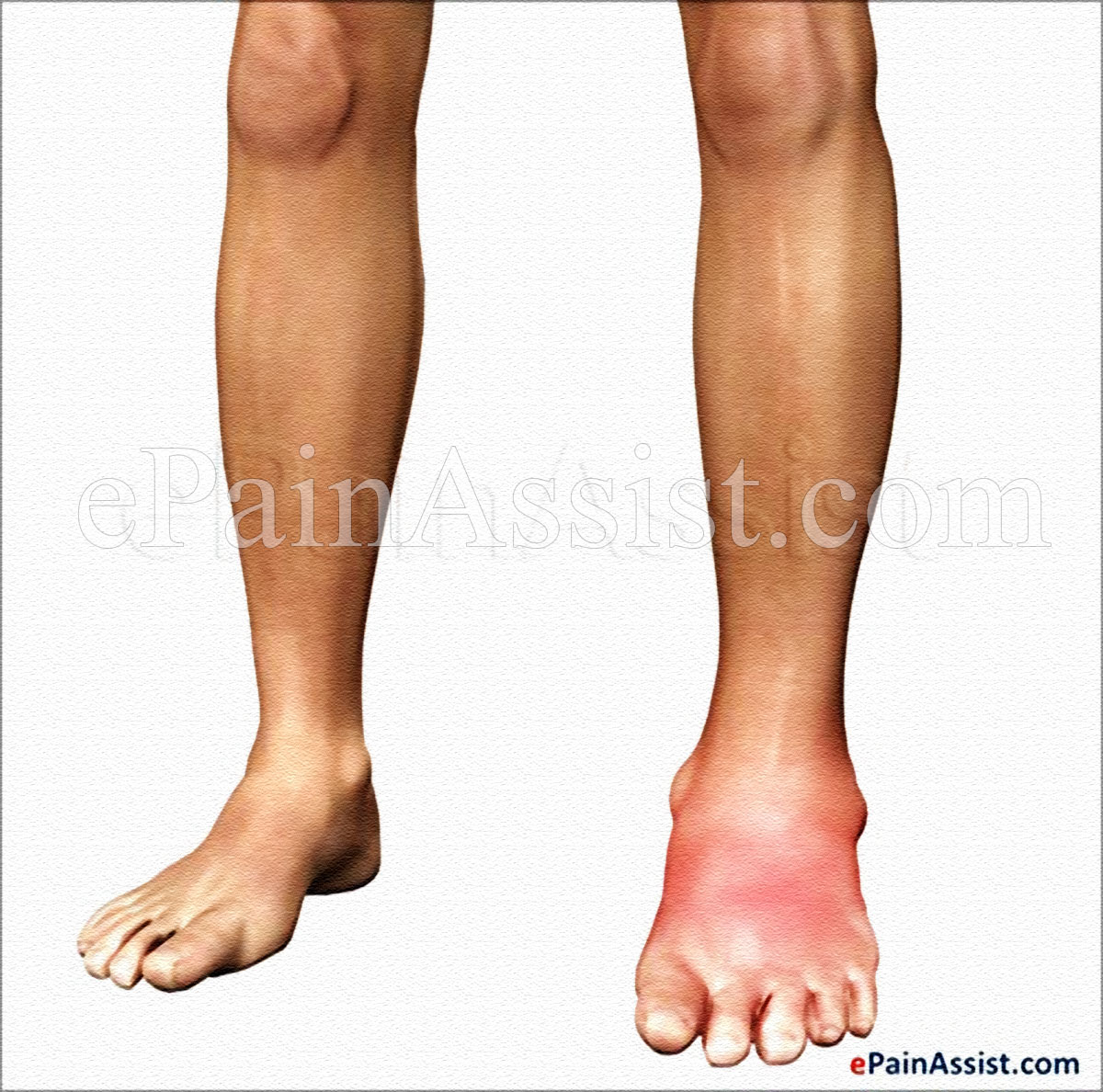 C1 Esterase Inhibitor Deficiency C1 Esterase Inhibitor Deficiency