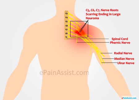 Cervicalnerve-Root