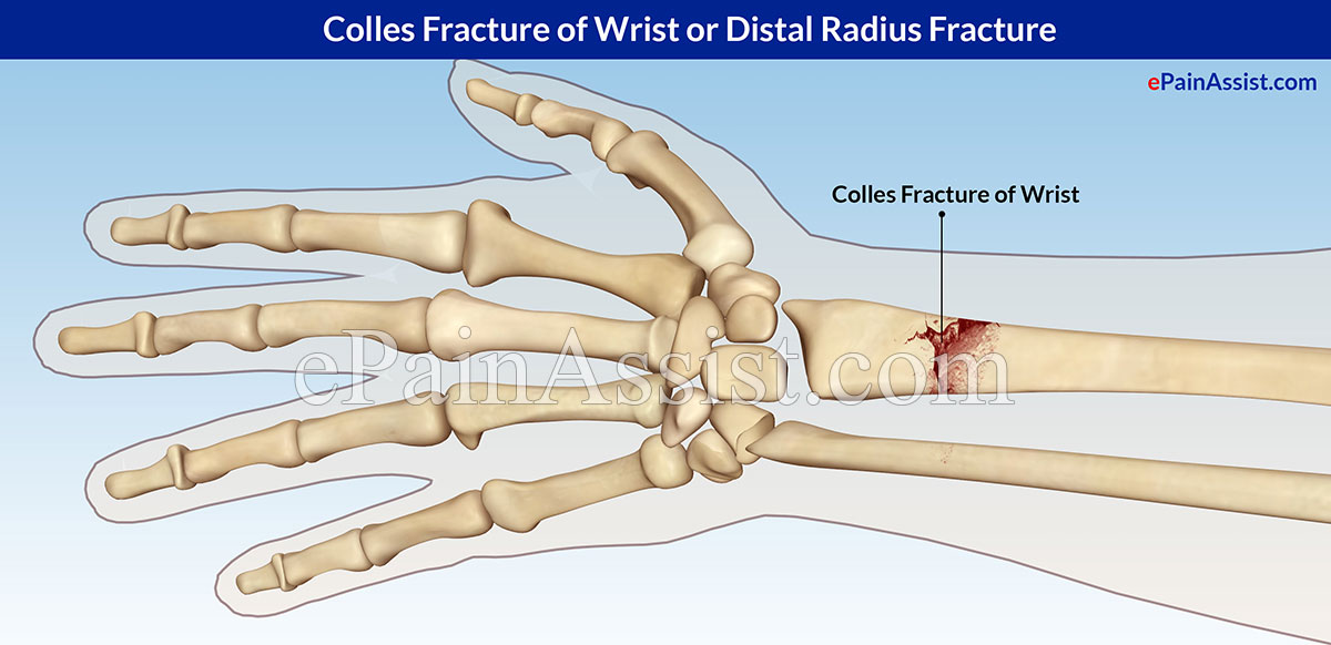 Colles Fracture of Wrist or Distal Radius Fracture Colles Fracture of Wrist or Distal Radius Fracture