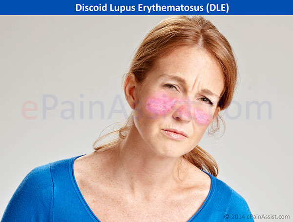 Discoid Lupus Erythematosus