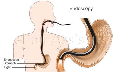 Endoscopy for Abdominal Pain or Stomach Ache