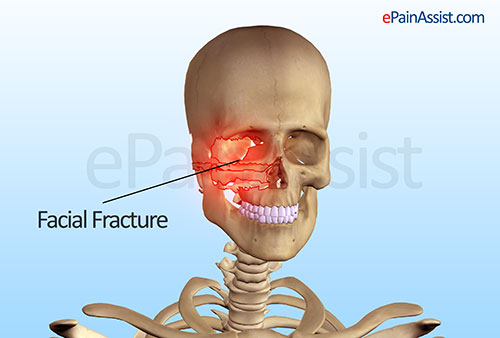 zygomatic arch fracture treatment