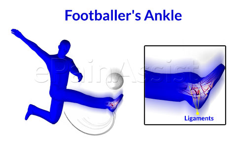 Footballer S Ankle Causes Symptoms Treatment Exercises