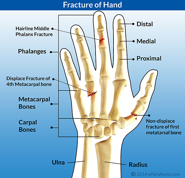 Fracture Of Hand And Fingers Risk Factors Causes Types Symptoms Signs 