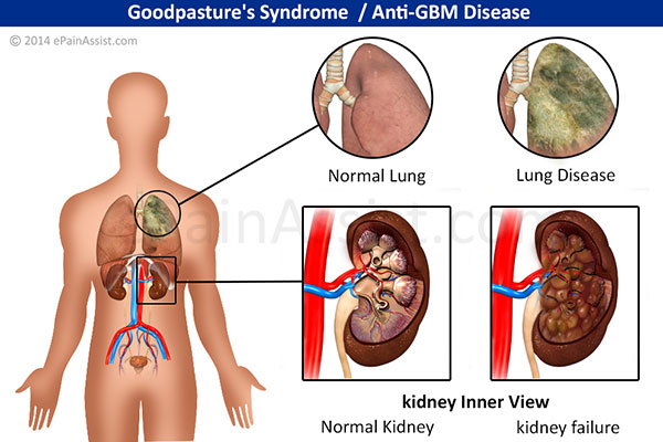 Goodpasture's Syndrome